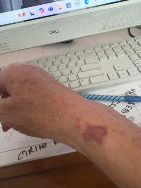 I am 70 and I’m sick of these bruises