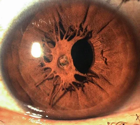 An iris growing over a pupil.