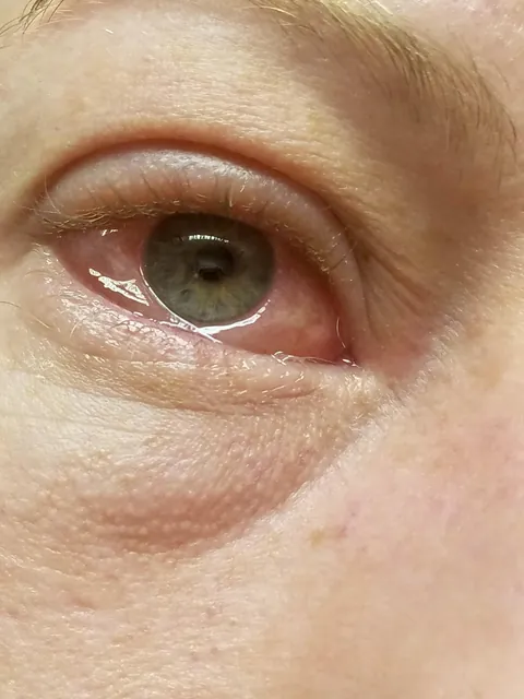 That time the white of my eye swelled up around the iris