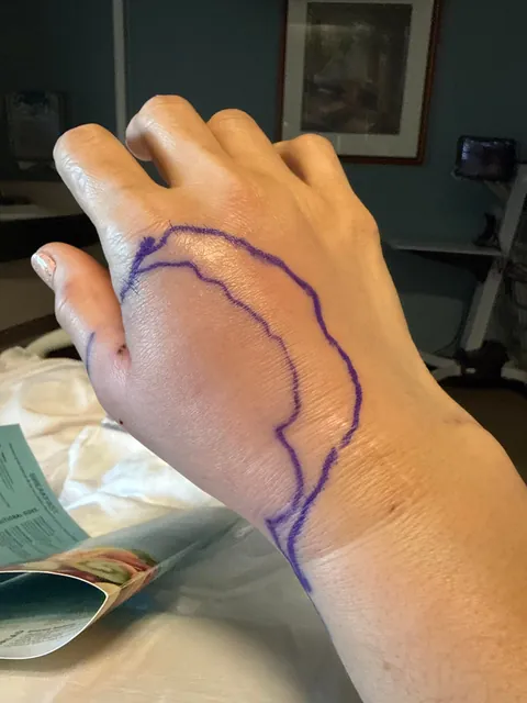 Just a reminder how serious cat bites can be!