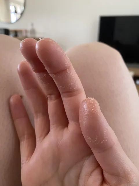 Yesterday i was pruning my tomato plants. Today my fingers started shedding