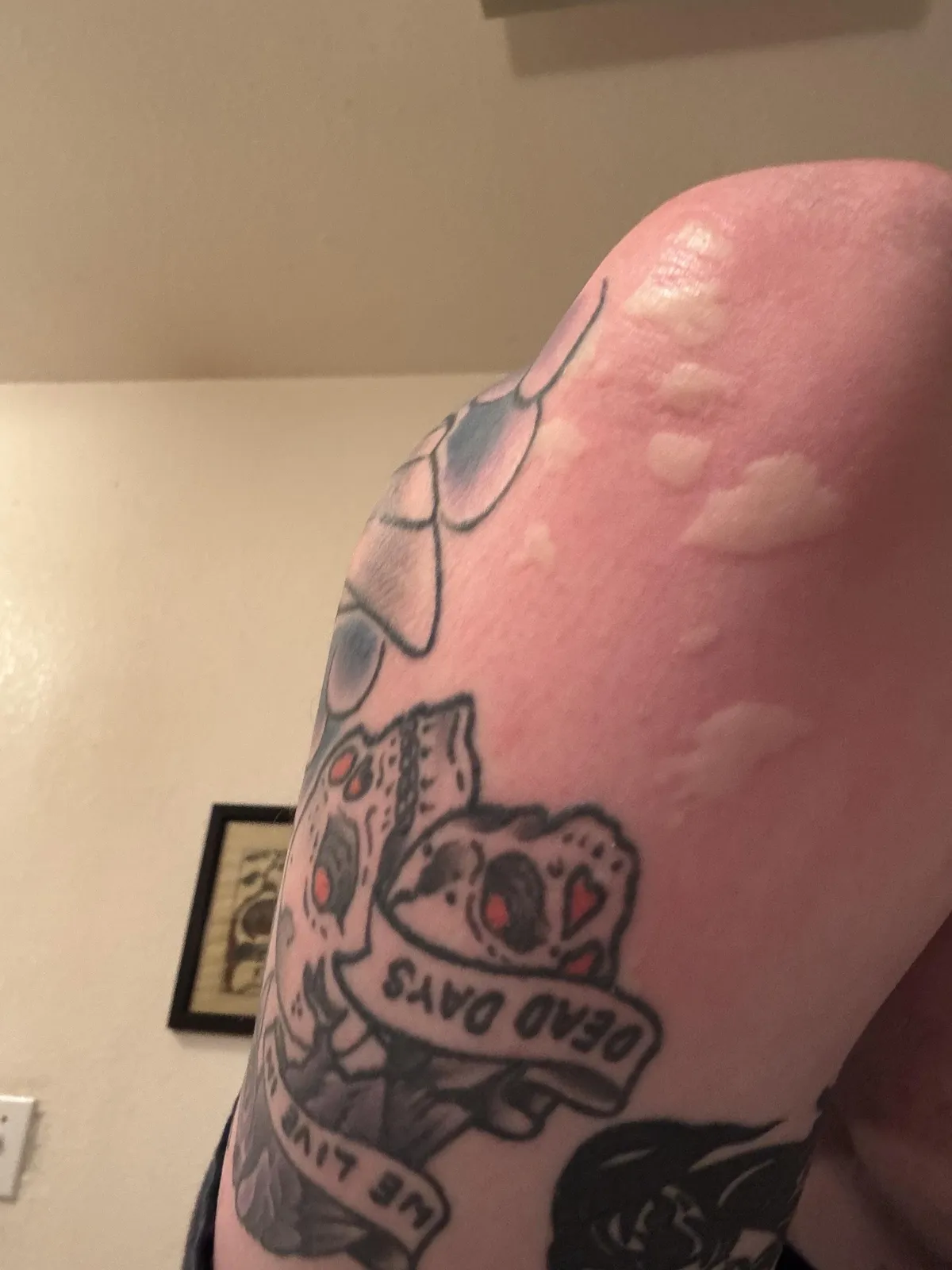 I am a magnet to mosquitos. This is from standing outside for 15 minutes tonight