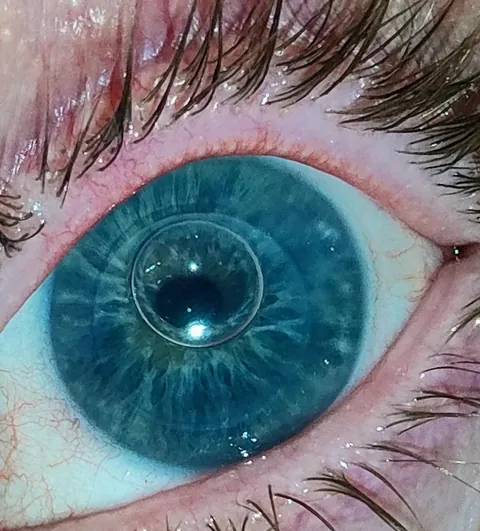 Eye bubble after corneal transplant