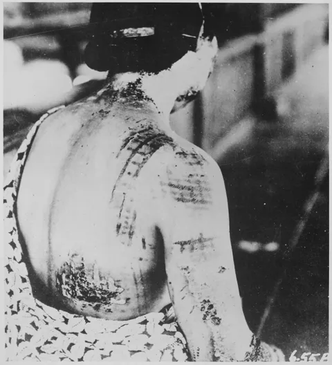 A woman from Hiroshima showing her back where her skin is burned in a pattern of the kimono worn at the time of the explosion, 1945