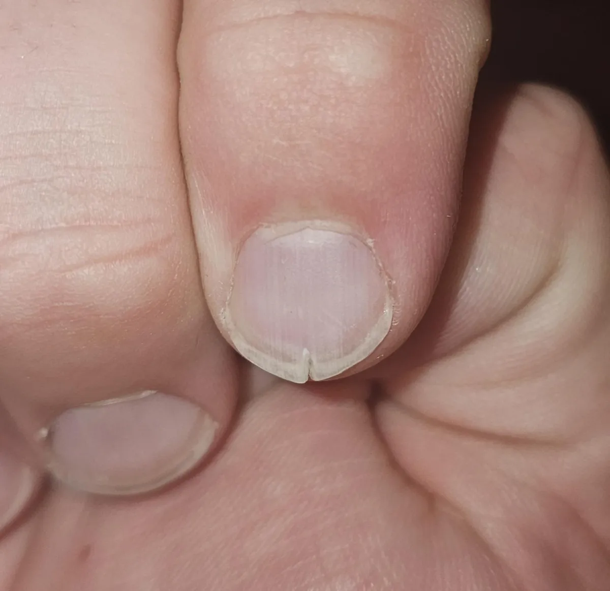 My fingernail has had a split in it for four years. 