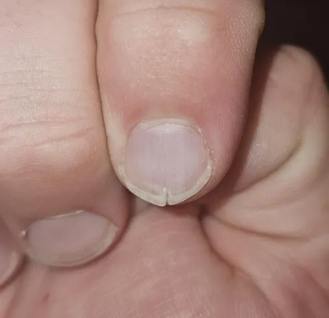 My fingernail has had a split in it for four years. 