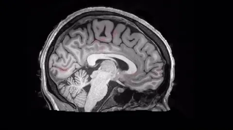 When we sleep, waves of spinal fluid wash over the brain to remove waste