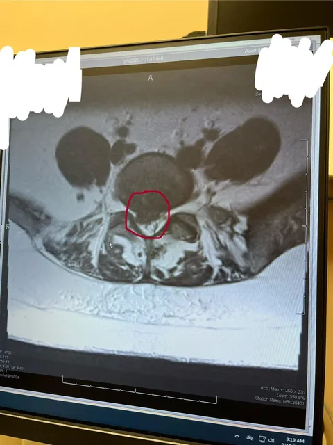 Been having severe back pain off and on for 5 years… kept getting told it was sciatica… guess what? Better! Herniated disk