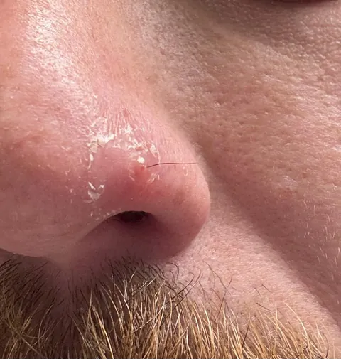 I popped a huge pimple that turned out to be an ingrown nose hair that worked its way to the outside and shot out