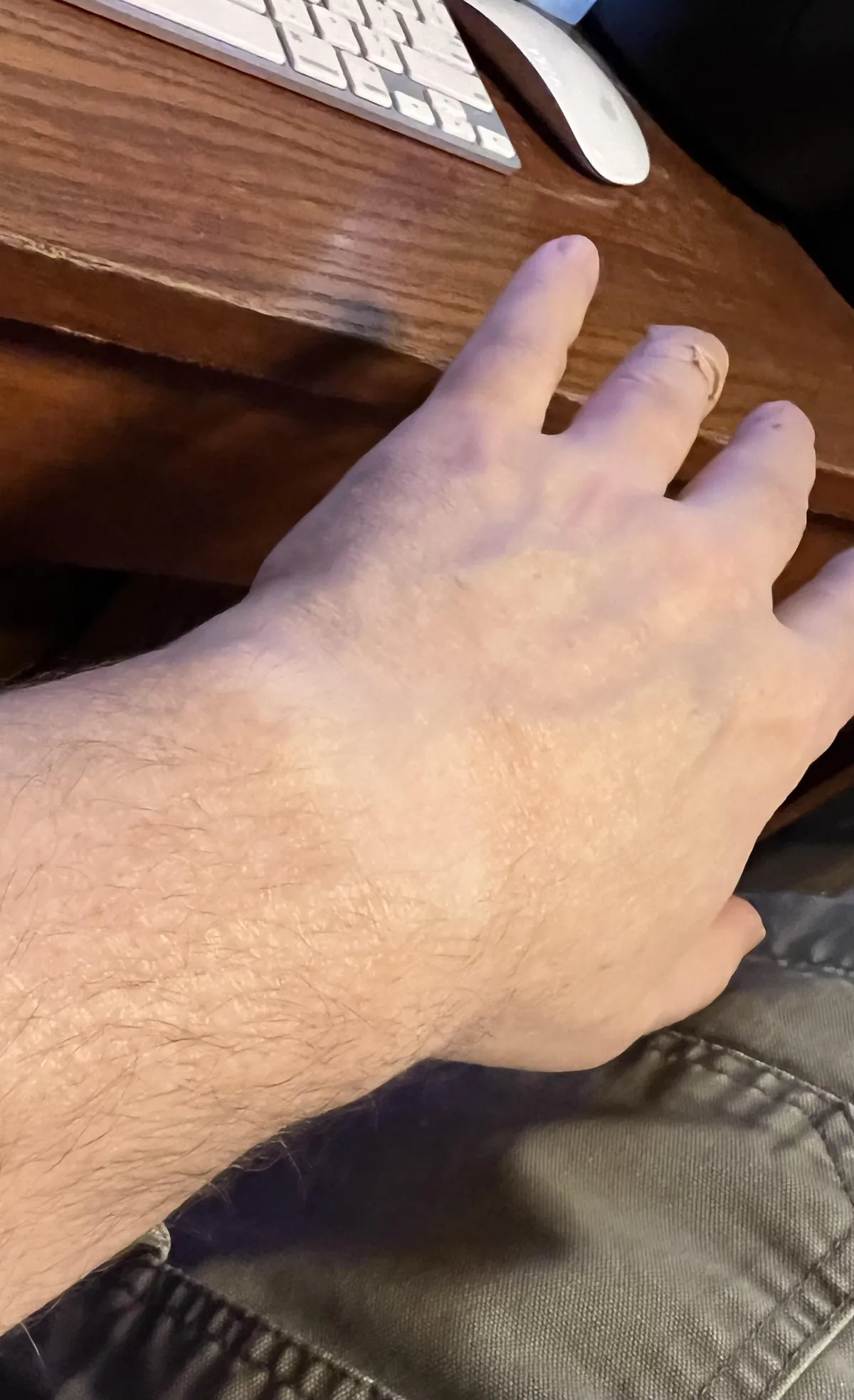 I have not worn a watch for over 10 years, but you can still see where it used to be on my arm.