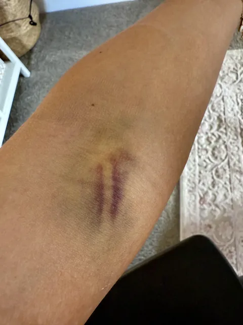 My bruise after blood draw is the shape of my vein