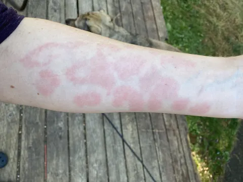 The rash I get when I touch seafood kinda looks like animal print