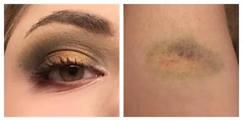 A Subculture look... inspired by the monster bruise on my leg 😭