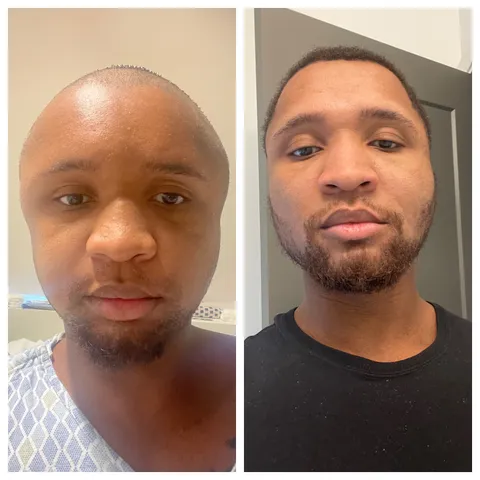 [OC] Had my facial reconstruction surgery 2 months ago. Was called Megamind, Ken Griffey Jr, Jimmy Nuetron, etc etc. 8 weeks later and feeling a lot more confident in how I look 😊