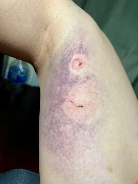 Bruising pattern from crowd control foam bullet avoids the point of impact