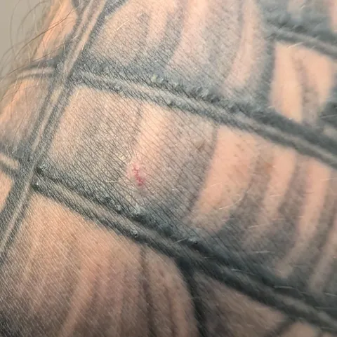 I'm suddenly forming itchy bumps along some of the lines of my 7 year old tattoo