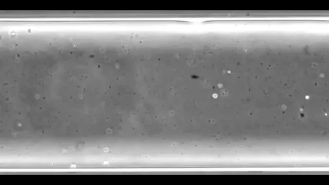 The 1st pregnancy via A.I. detected sperm (by finding 5 motile sperm in 2.5 million images) from a 39-year-old man with infertility.