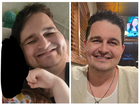 After 7 years of living with only 6 bottom teeth,my husband was finally able to get dental implants. I've never seen him so happy and confident!