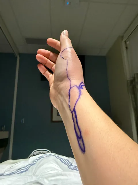 Just a reminder how serious cat bites can be!